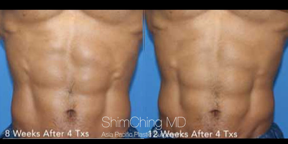 TruSculpt Flex Before & After Gallery - Patient 179755336 - Image 2