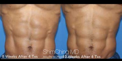 TruSculpt Flex Before & After Gallery - Patient 179755336 - Image 2