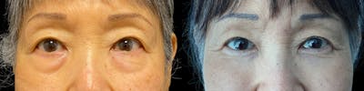 Asian Eyelid Before & After Gallery - Patient 179752100 - Image 1