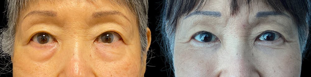 Eyelid Surgery Before & After Gallery - Patient 179752095 - Image 1