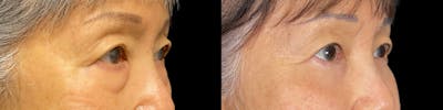 Asian Eyelid Before & After Gallery - Patient 179752100 - Image 2