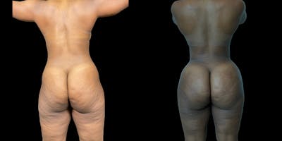 Brazilian Butt Lift Before & After Gallery - Patient 337367 - Image 1