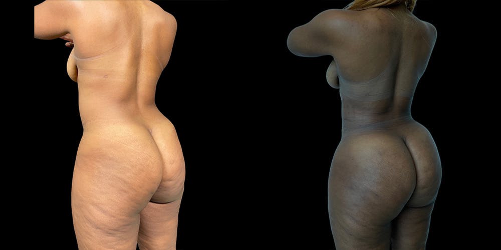 Brazilian Butt Lift Before & After Gallery - Patient 337367 - Image 2