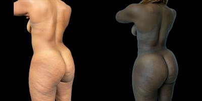 Brazilian Butt Lift Before & After Gallery - Patient 337367 - Image 2