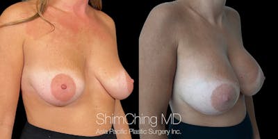 Breast Augmentation Before & After Gallery - Patient 966808 - Image 1