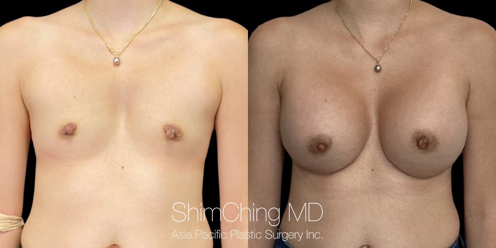 Breast Augmentation Before & After Gallery - Patient 389562 - Image 1