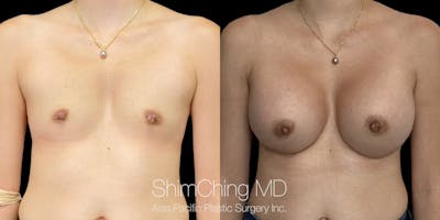 Breast Augmentation Before & After Gallery - Patient 389562 - Image 1