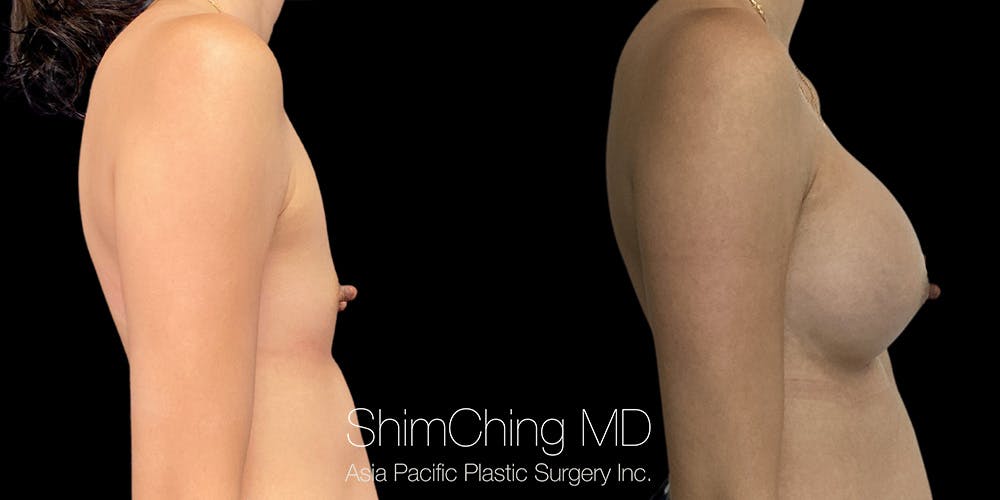 Breast Augmentation Before & After Gallery - Patient 389562 - Image 3