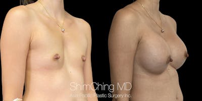 Asian Breast Implants Before & After Gallery - Patient 118601 - Image 2