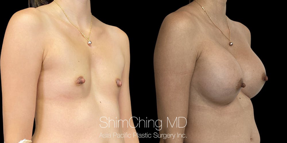Breast Augmentation Before & After Gallery - Patient 389562 - Image 2