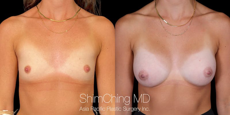 Breast Augmentation results in Honolulu, Hawaii with Dr. Shim Ching