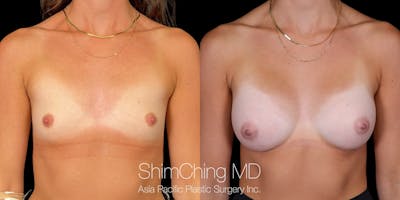 Breast Augmentation Before & After Gallery - Patient 255303 - Image 1