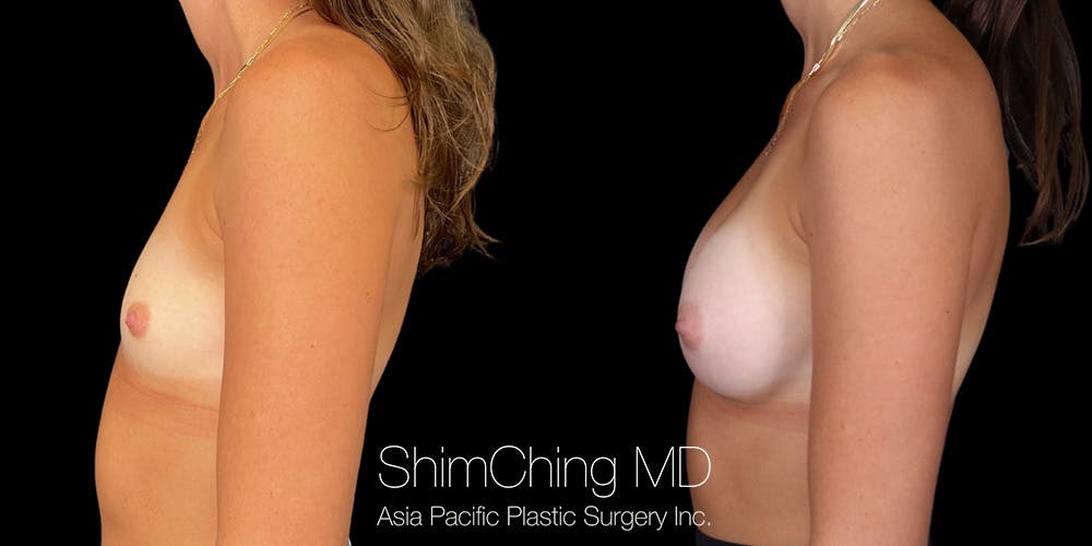 Breast Augmentation Before & After Gallery - Patient 255303 - Image 3