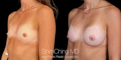 Breast Augmentation Before & After Gallery - Patient 255303 - Image 2