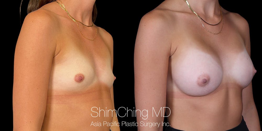 Breast Augmentation Before & After Gallery - Patient 255303 - Image 4