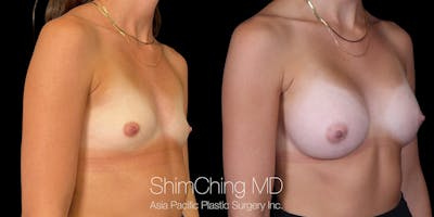 Breast Augmentation Before & After Gallery - Patient 255303 - Image 4