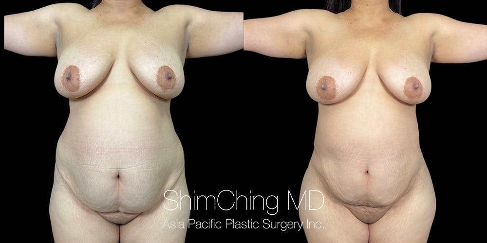 Laser Liposuction Before & After Gallery - Patient 206745 - Image 1