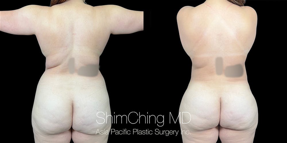 Laser Liposuction Before & After Gallery - Patient 206745 - Image 3