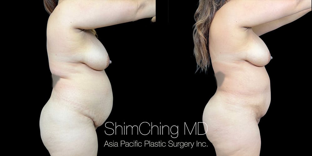 Laser Liposuction Before & After Gallery - Patient 206745 - Image 2
