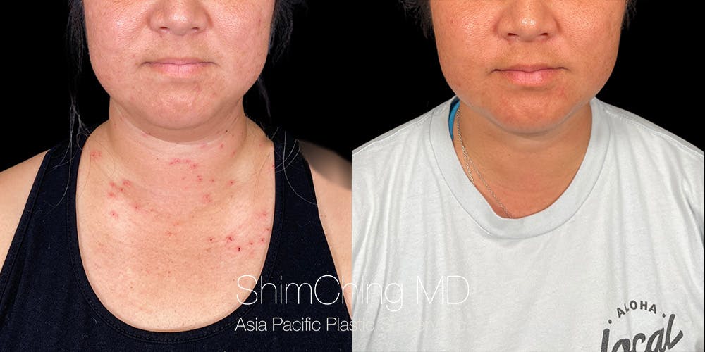 Laser Liposuction Before & After Gallery - Patient 148771 - Image 2