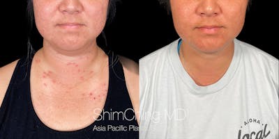 Laser Liposuction Before & After Gallery - Patient 148771 - Image 2