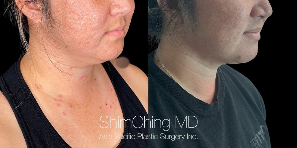 Laser Liposuction Before & After Gallery - Patient 148771 - Image 1