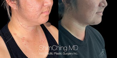 Laser Liposuction Before & After Gallery - Patient 148771 - Image 1
