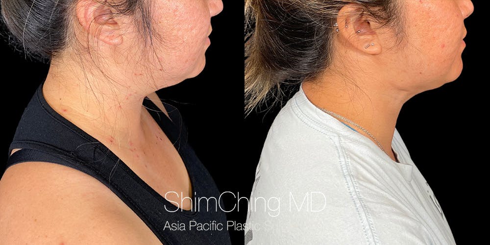 Laser Liposuction Before & After Gallery - Patient 148771 - Image 3