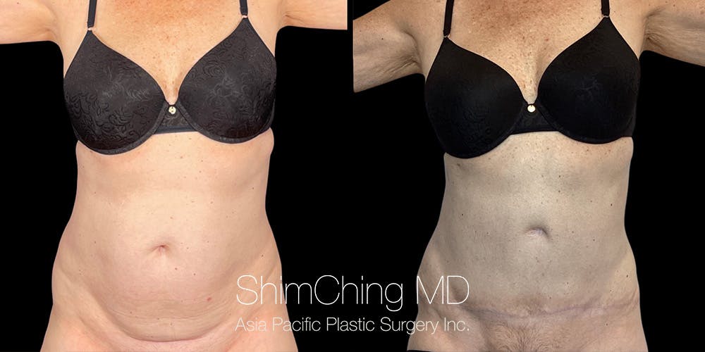 Tummy Tuck Before & After Gallery - Patient 294935 - Image 1