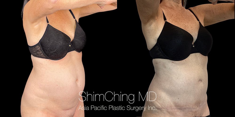 Tummy Tuck Before & After Gallery - Patient 294935 - Image 3