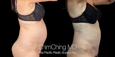 Tummy Tuck Before & After Gallery - Patient 294935 - Image 2