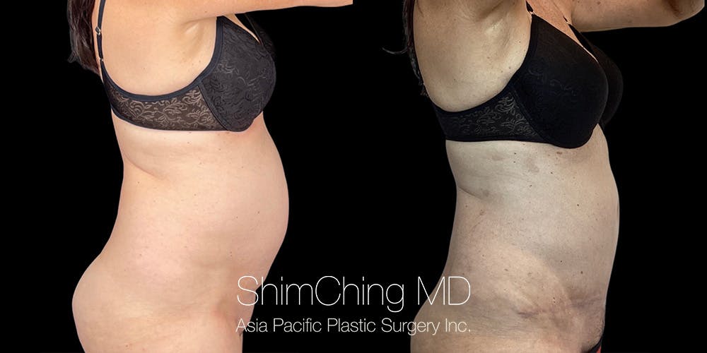 Tummy Tuck Before & After Gallery - Patient 294935 - Image 2