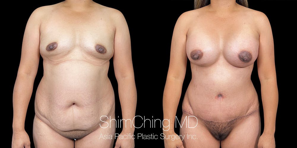 Mommy Makeover Before & After Gallery - Patient 157932 - Image 1
