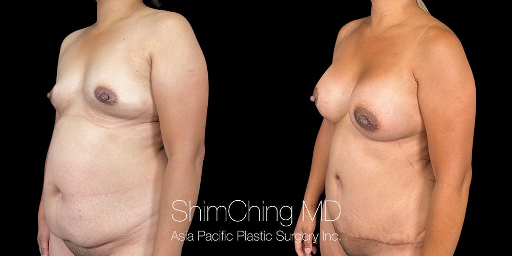 Tummy Tuck Before & After Gallery - Patient 286763 - Image 3