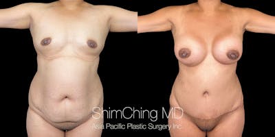 Tummy Tuck Before & After Gallery - Patient 286763 - Image 2