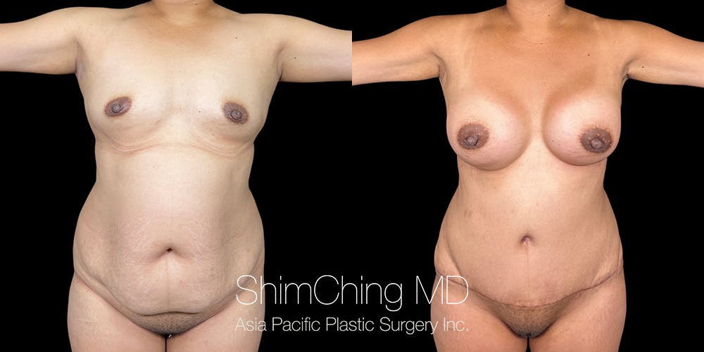 Tummy Tuck Before & After Gallery - Patient 286763 - Image 2