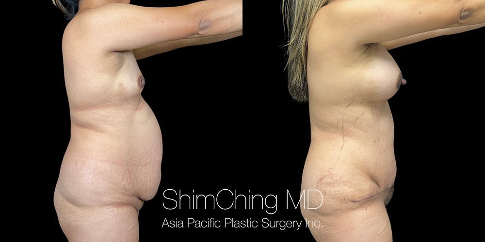 Tummy Tuck Before & After Gallery - Patient 286763 - Image 5