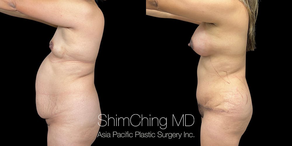 Tummy Tuck Before & After Gallery - Patient 286763 - Image 4