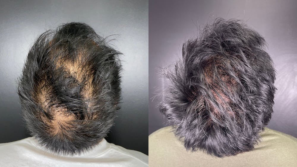 Hair Restoration Before & After Gallery - Patient 304067 - Image 2