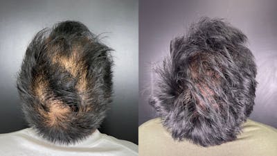 Hair Restoration Before & After Gallery - Patient 304067 - Image 2