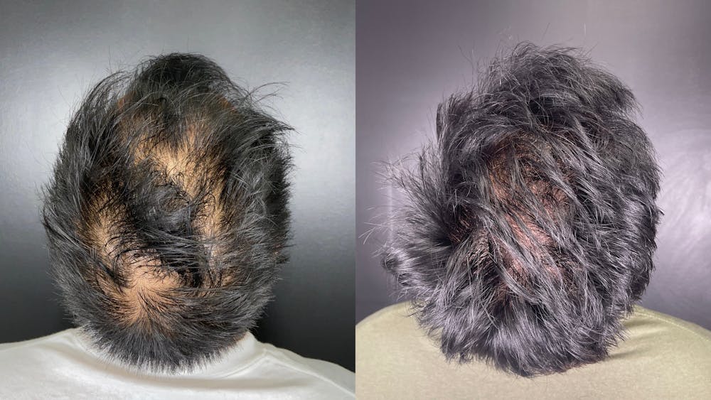 Hair Restoration Before & After Gallery - Patient 233815 - Image 2