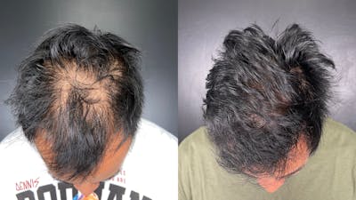 Hair Restoration Before & After Gallery - Patient 304067 - Image 1