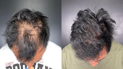 Hair Restoration Before & After Gallery - Patient 233815 - Image 1