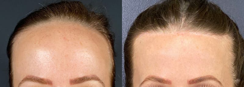 Forehead Lowering Surgery