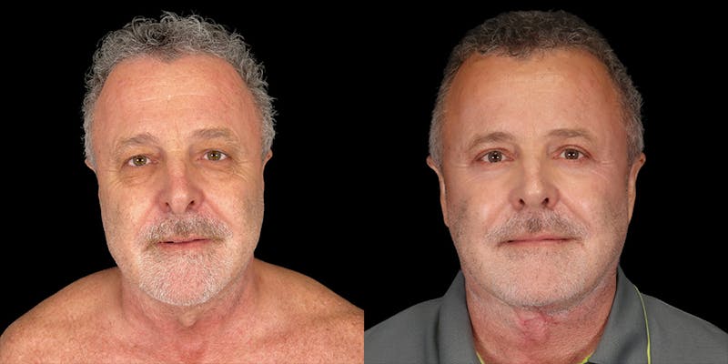 Before and after Facelift surgery in Honolulu with Dr. Shim Ching