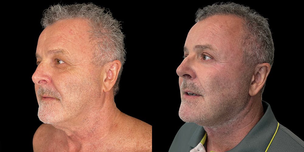 Facelift Before & After Gallery - Patient 357763 - Image 2