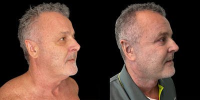 Neck Lift Before & After Gallery - Patient 132510 - Image 4