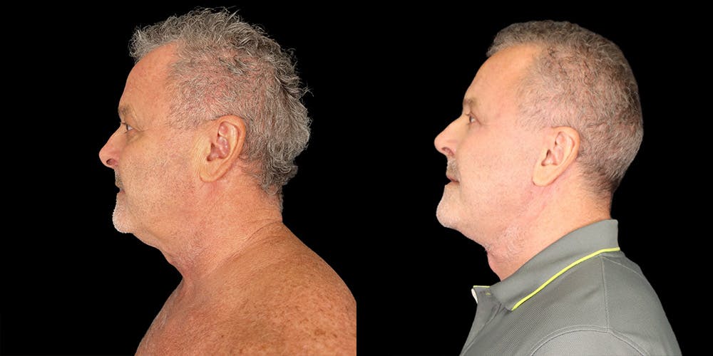 Facelift Before & After Gallery - Patient 357763 - Image 4