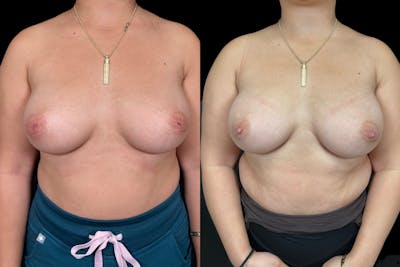 Inverted Nipple Correction Before & After Gallery - Patient 338016 - Image 1