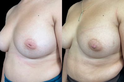 Inverted Nipple Correction Before & After Gallery - Patient 338016 - Image 2